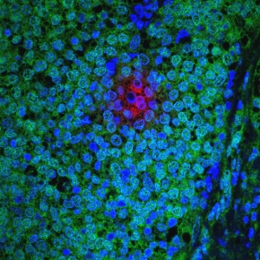 breast cancer cells